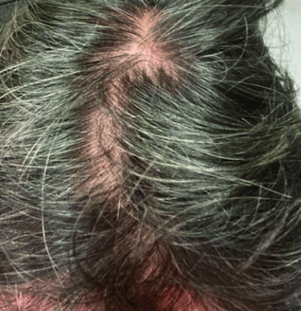 Volunteer C before treatment, original scalp photograph supplied by Vivipharma