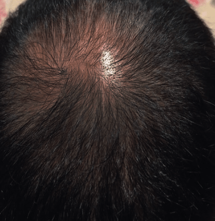 Volunteer D after treatment, original scalp photograph supplied by Vivipharma
