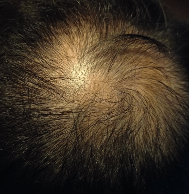 Volunteer D before treatment, original scalp photograph supplied by Vivipharma